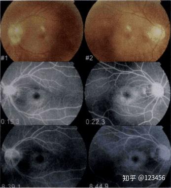 最新藥肺炎詳解，你需要知道的一切——健康小紅書